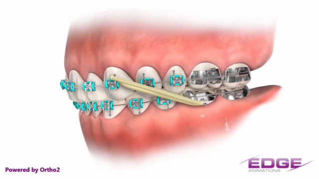 elastics (rubber bands)