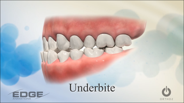 underbite