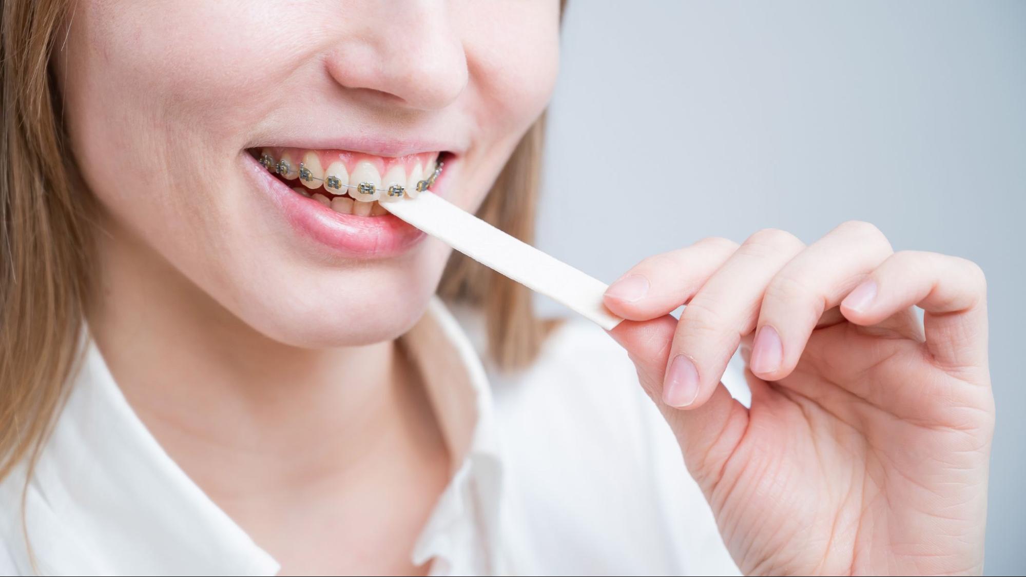 5 Foods To Avoid With Braces